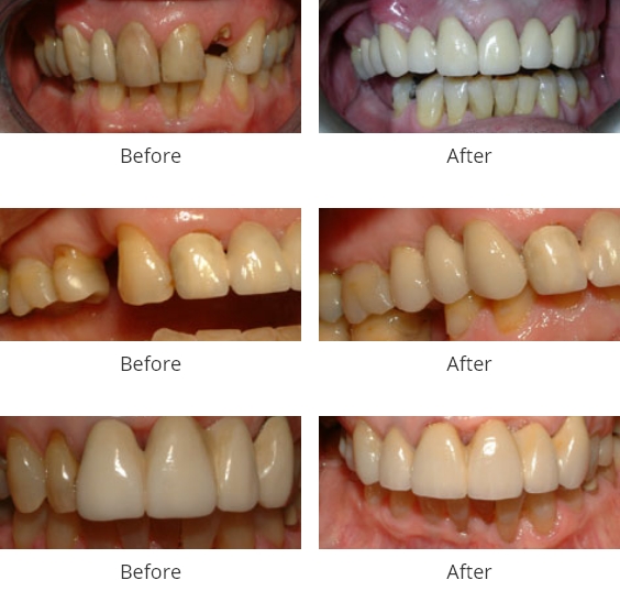 Bridges Treatment before and after