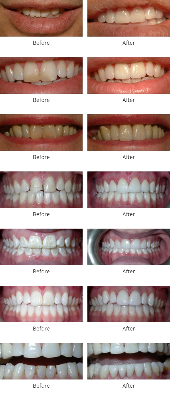 Veneers treatment before and after
