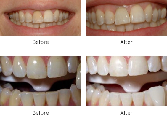 whitening treatment before and after